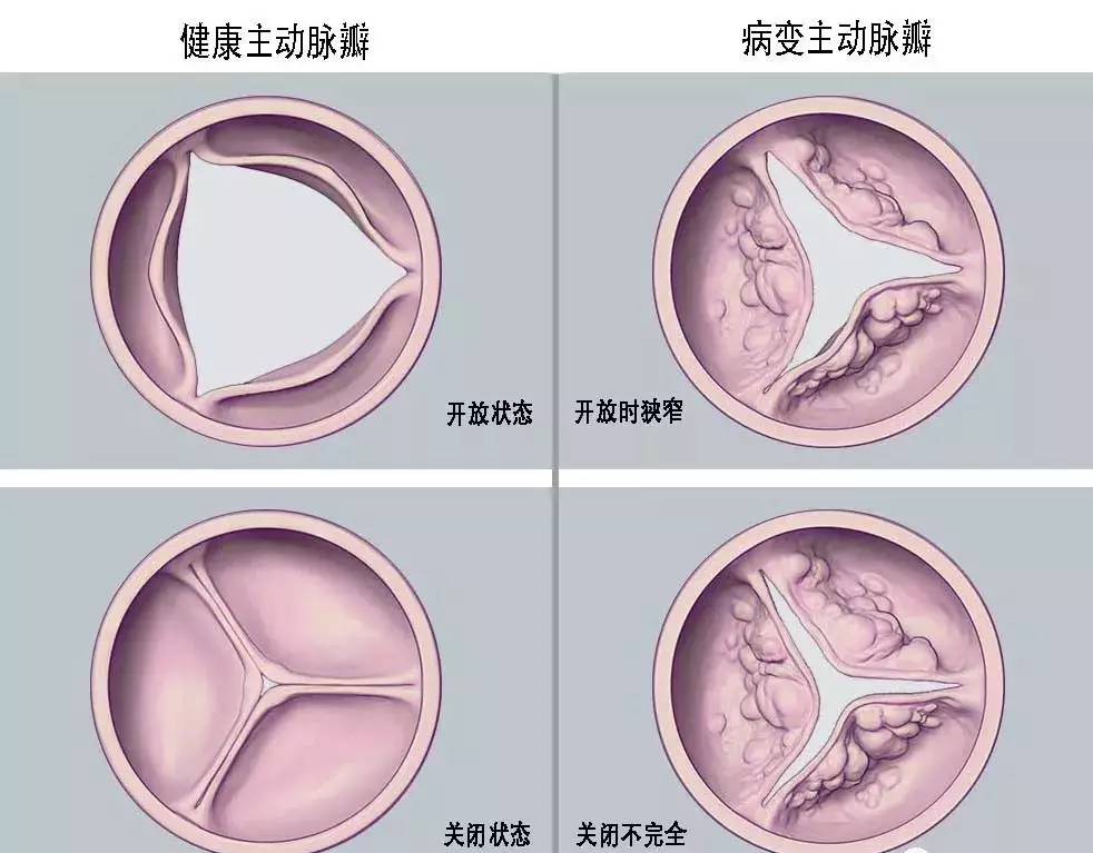 心脏换瓣膜技术的最新进展与革新