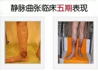 老烂腿新疗法揭秘，温馨疗法日常故事中的奇遇之路