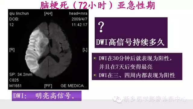 脑梗塞分期的最新标准，小巷深处的医学奥秘与美食探寻